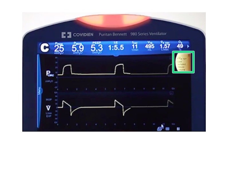 Resetting the Tidal Volume Alarm in Settings iFixit Repair Guide